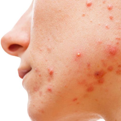 Acne Cure